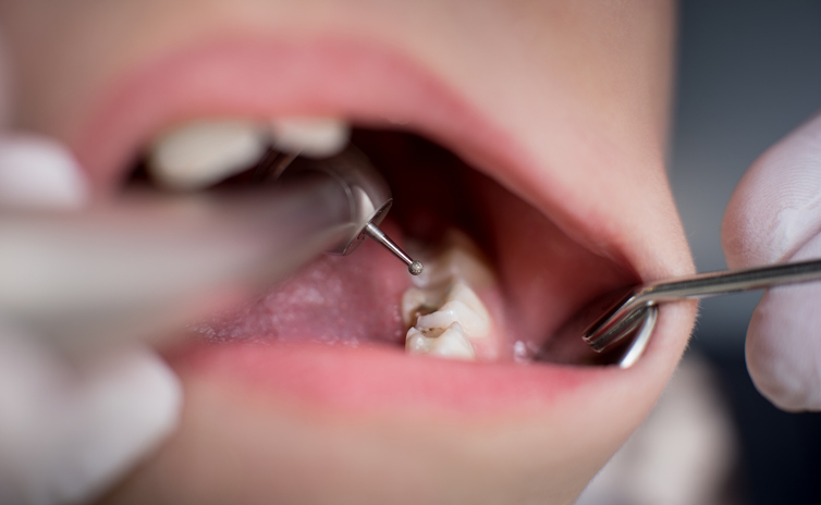Can The Probe Used During My Regular Check-up Damage Teeth?